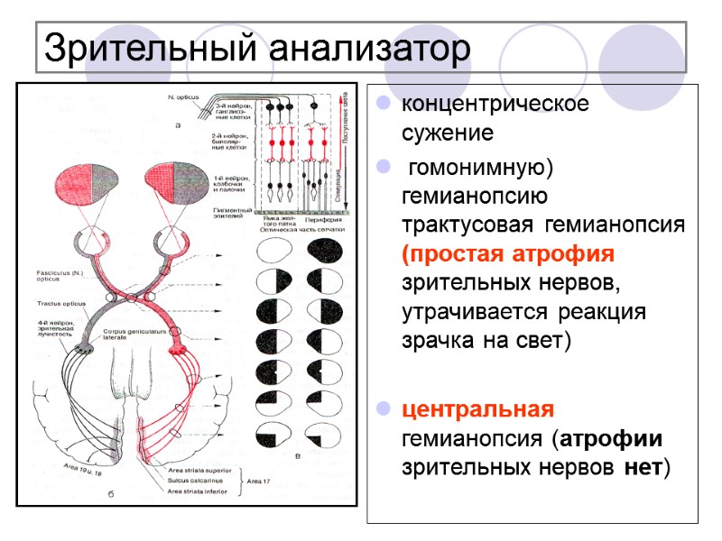 Зрительный анализатор концентрическое сужение  гомонимную) гемианопсию трактусовая гемианопсия (простая атрофия зрительных нервов, утрачивается
